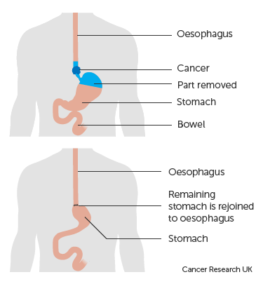 image-oesophagus image from CRUK.png